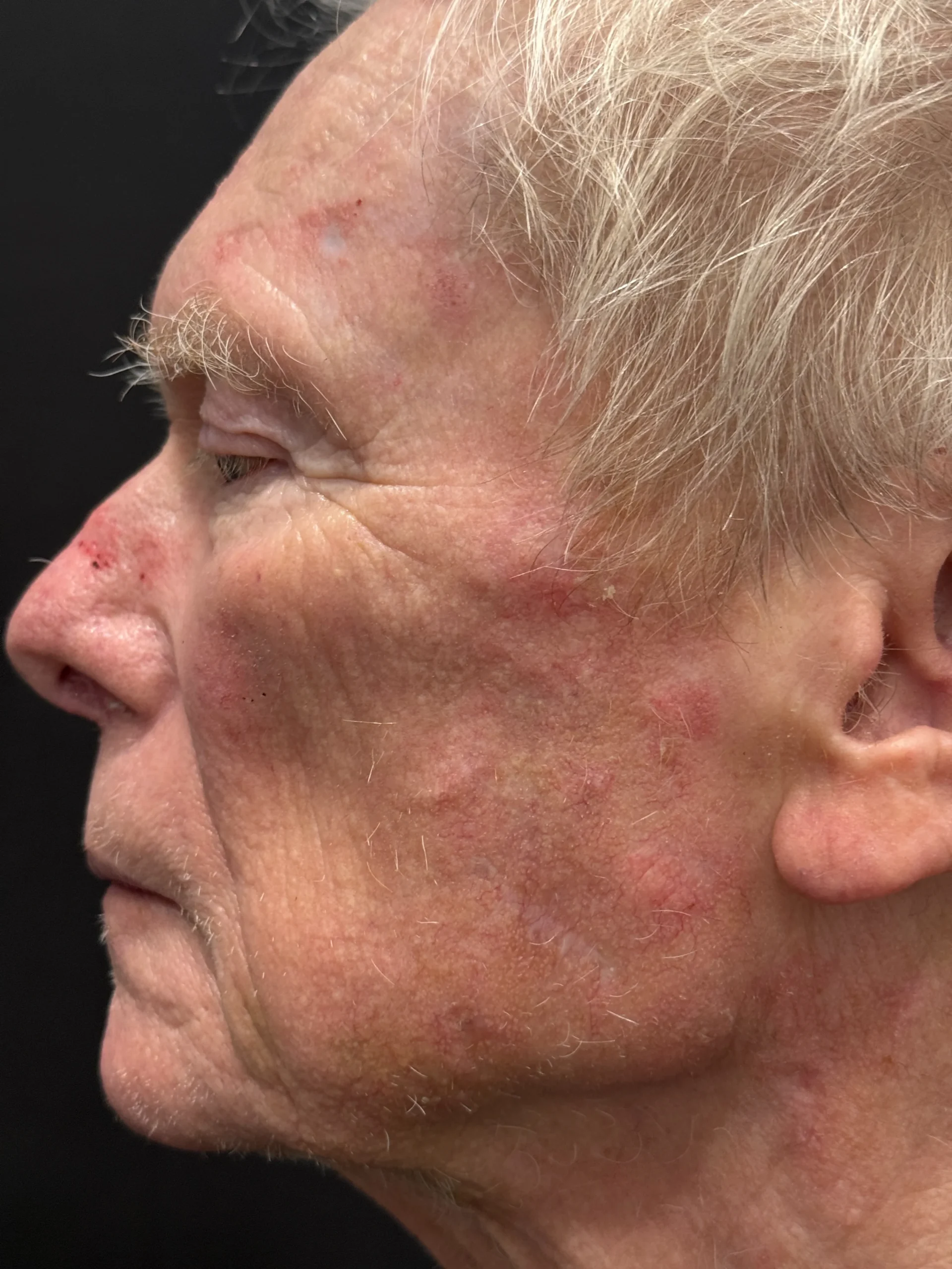 BussoLyft cog thread lift after, male patient of Dr. Ellen Turner in Dallas