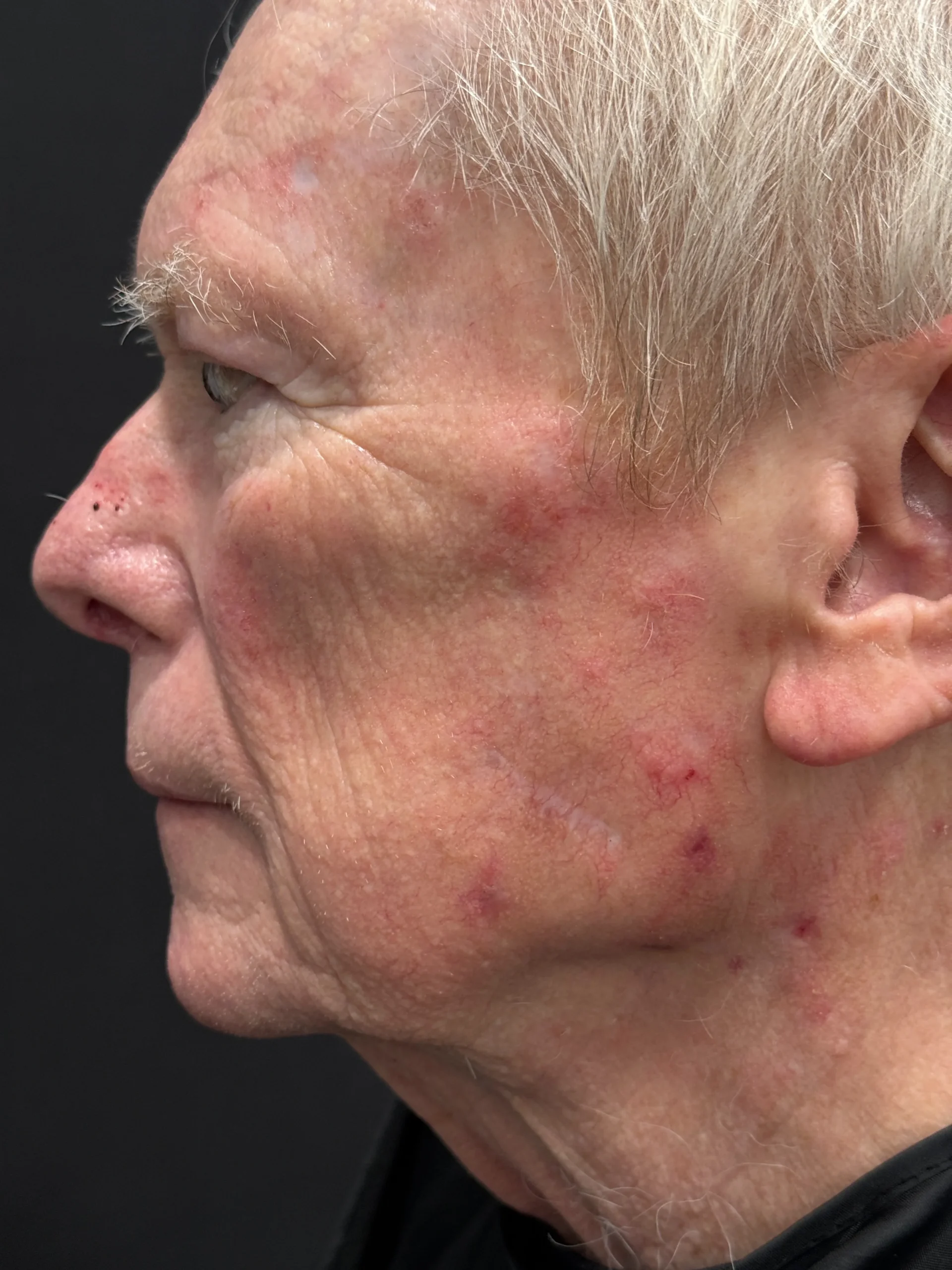 BussoLyft cog thread lift before, male patient of Dr. Ellen Turner in Dallas