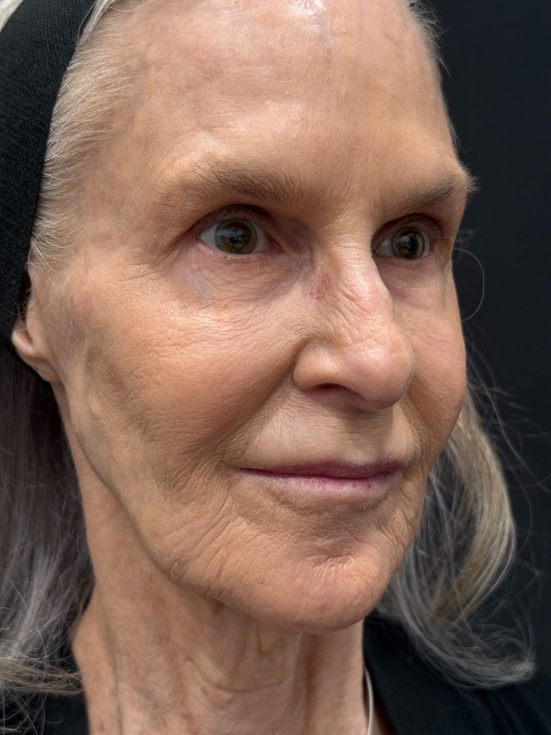 BussoLyft cog thread facial lift after, Dr. Ellen Turner Dallas patient