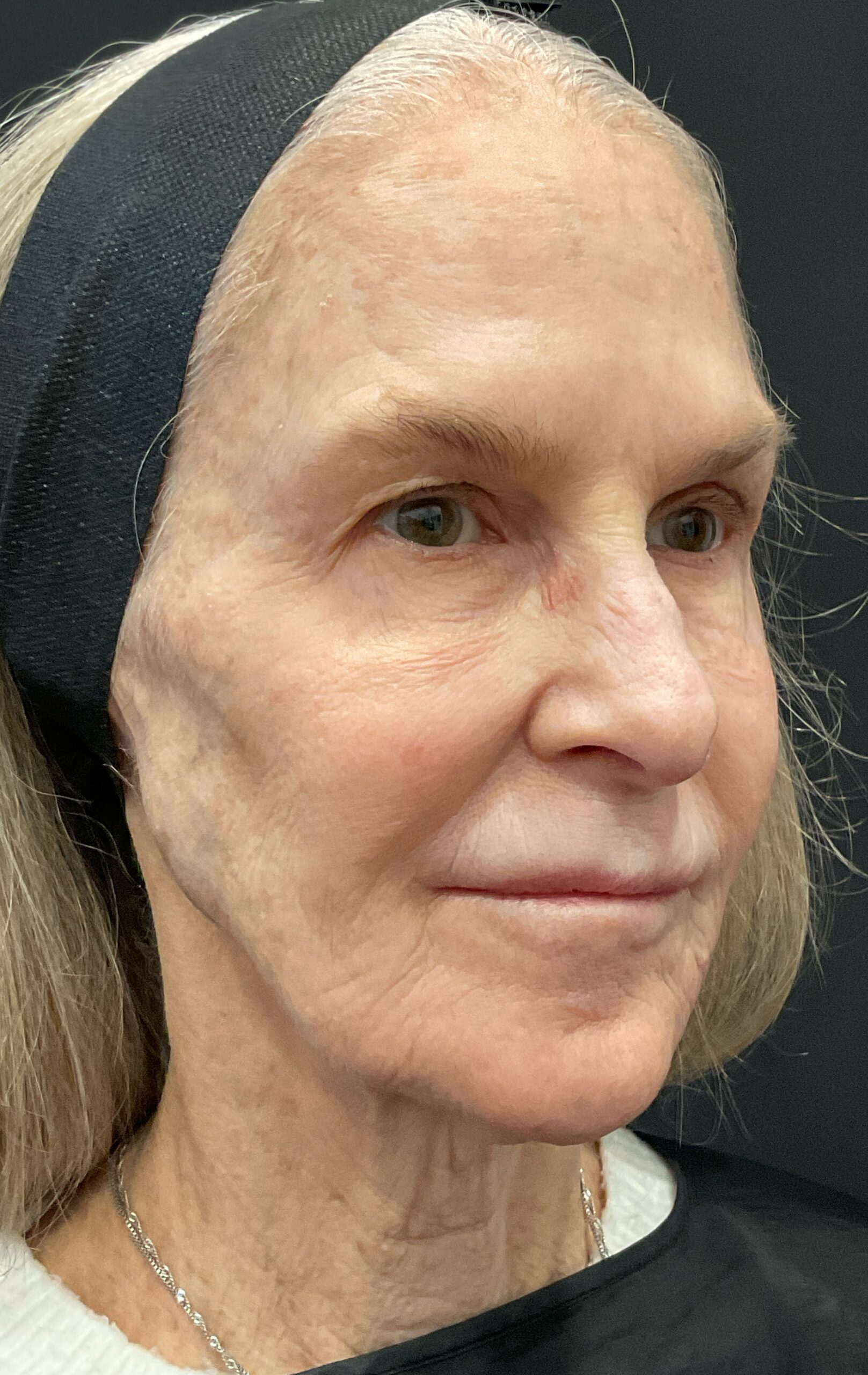 BussoLyft cog thread facial lift before, Dr. Ellen Turner Dallas patient