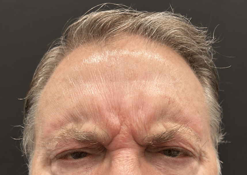 BussoLyft cog thread lift after, male patient of Dr. Ellen Turner in Dallas