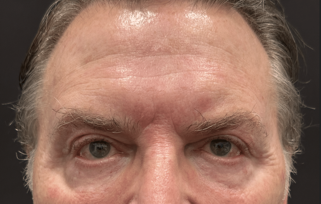 BussoLyft cog thread lift before, male patient of Dr. Ellen Turner in Dallas